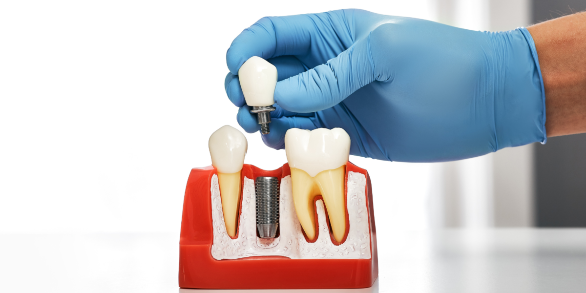 założenie implantu zębowego