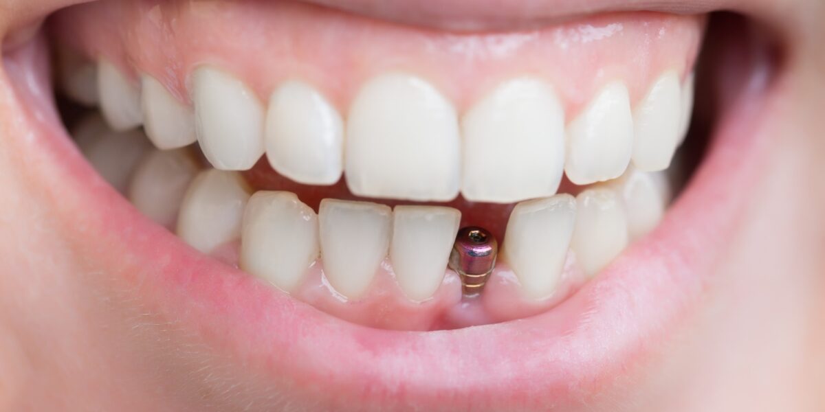 zęby a implanty