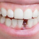 zęby a implanty
