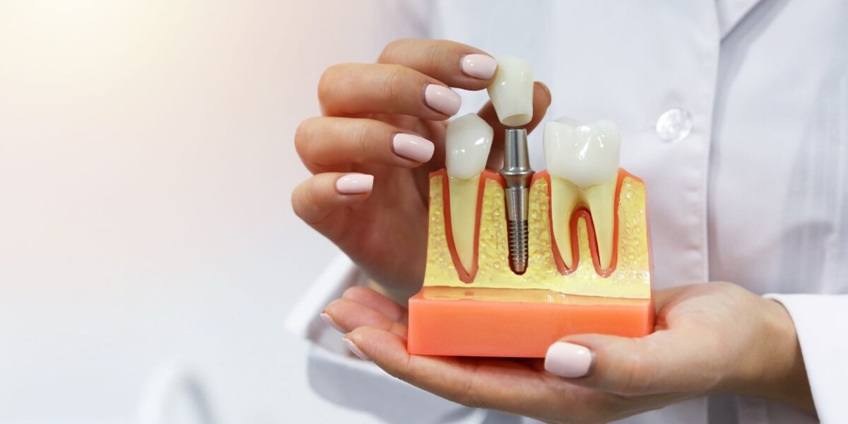 zalety implantów zębowych